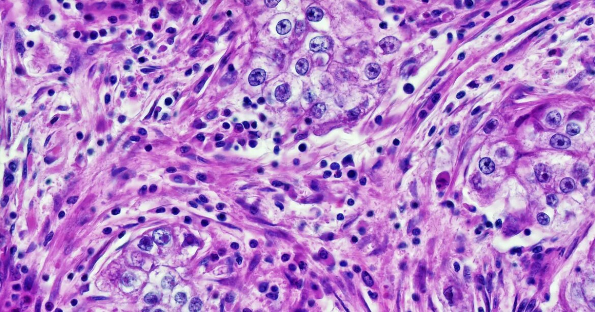 Doctors caught cancer-diagnosing AI extracting patients' racial data and being racist with it

