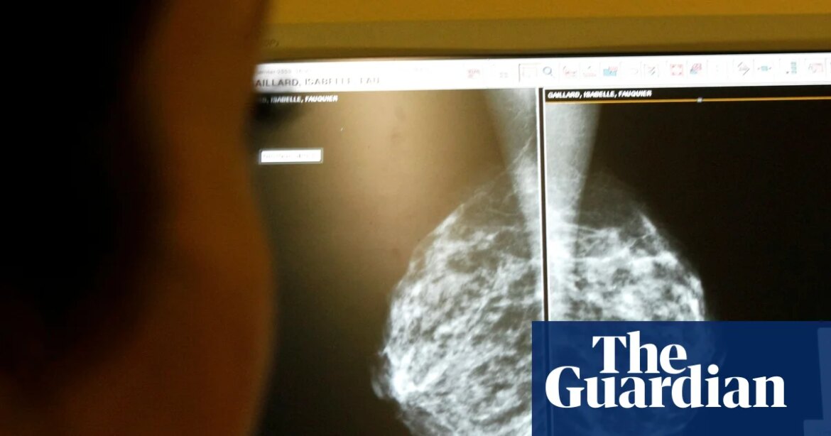 Study finds use of AI in breast cancer screening reduces late diagnosis rate by 12% Cancer Research

